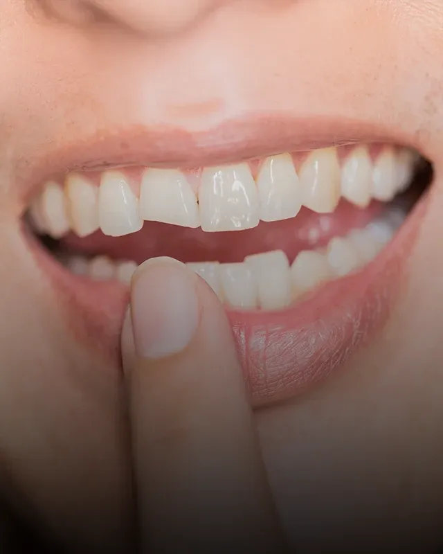 A patient pointing to a chipped tooth in their mouth